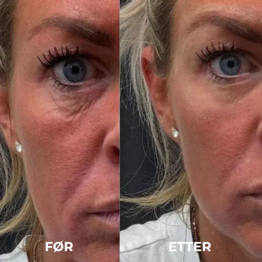 EyeGlow™ | Kollagen hydrogel øyepatcher